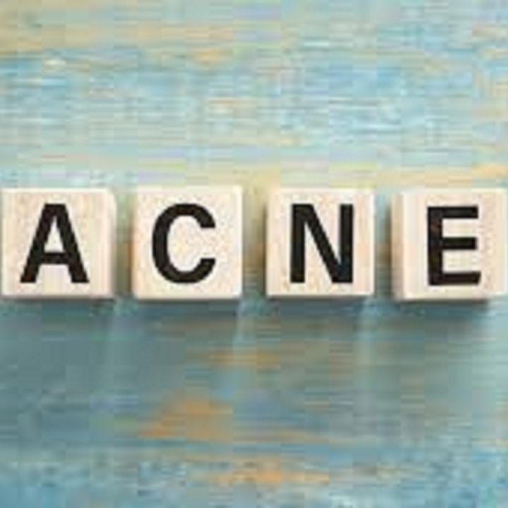 Home Remedies For Acne