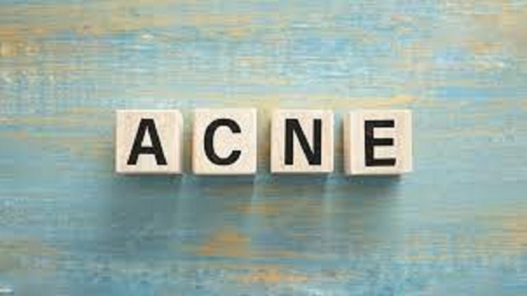 Home Remedies For Acne