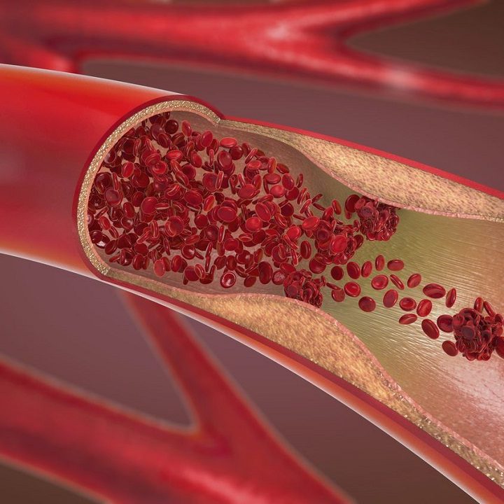 Home Remedies For Arteriosclerosis