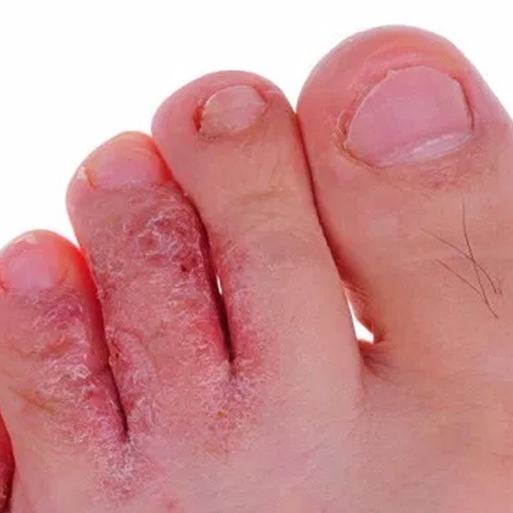 Home Remedies For Athlete's Foot
