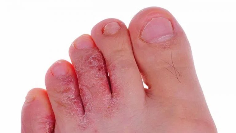 Home Remedies For Athlete’s Foot