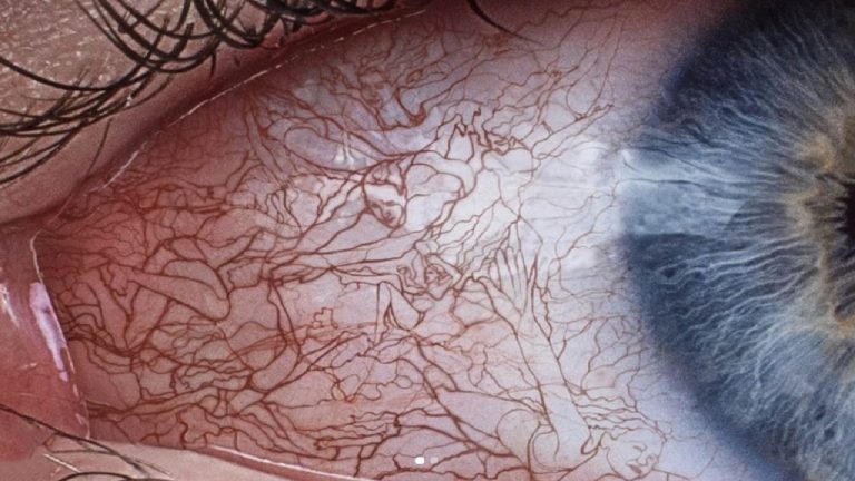 Home Remedies For Bloodshot Eyes