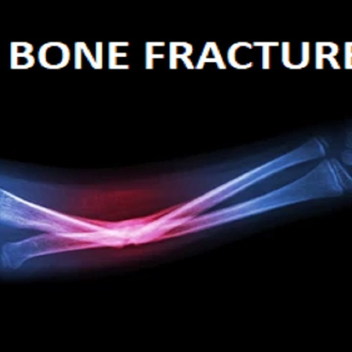Home Remedies For Bone Fracture