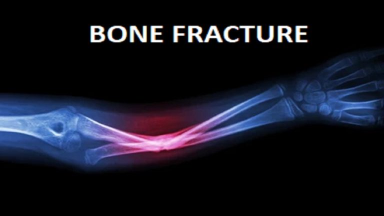 Home Remedies For Bone Fracture