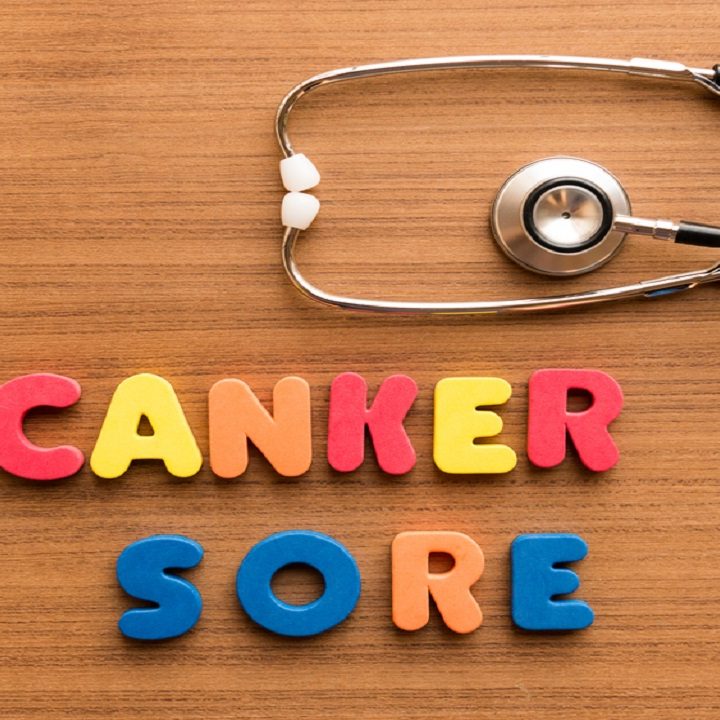 Home Remedies For Canker Sores