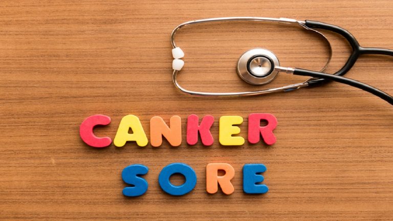 Home Remedies For Canker Sores