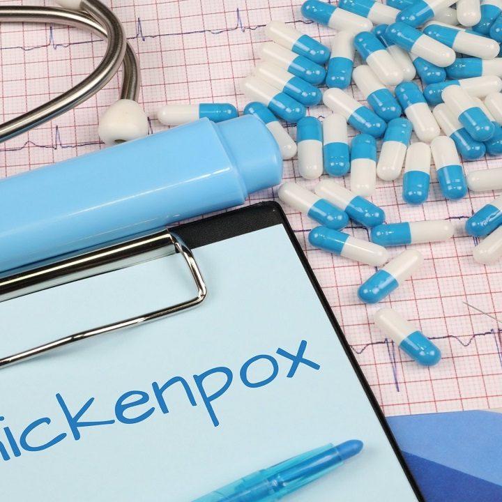 Home Remedies For Chickenpox