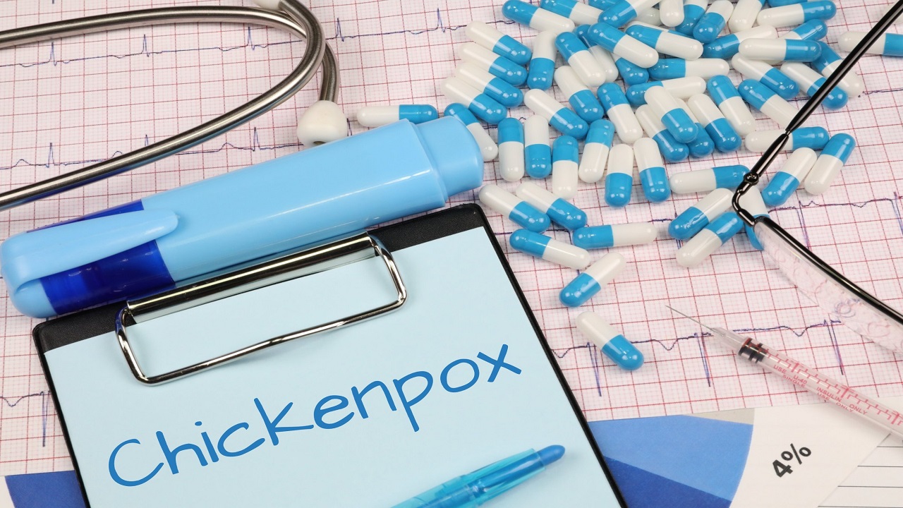 Home Remedies For Chickenpox